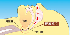 無呼吸症患者さんの気道状態