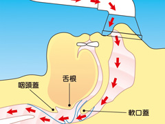 ＣＰＡＰ（持続陽圧呼吸療法：シーパップ）装置による治療